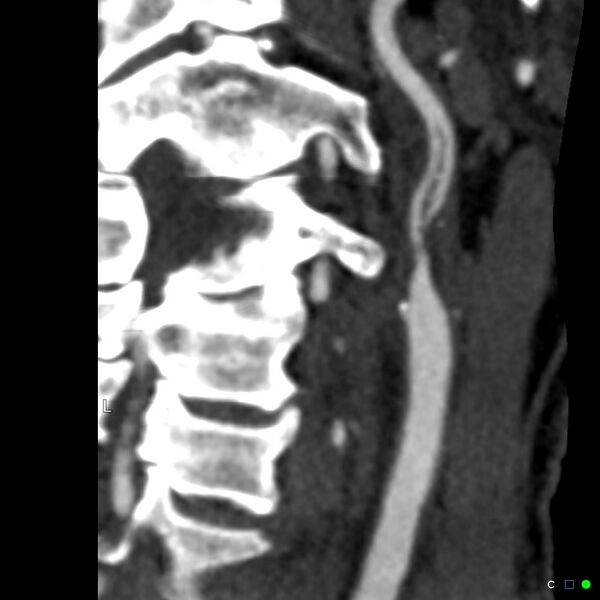 File:Non-occlusive intraluminal internal carotid artery thrombus (Radiopaedia 37751-39658 A 34).jpg
