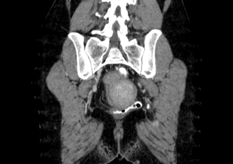 File:Non-puerperal uterine inversion (Radiopaedia 78343-91094 B 52).jpg