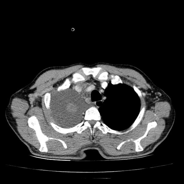 File:Non small-cell lung cancer (Radiopaedia 24467-24769 C+ delayed 13).jpg