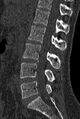 Normal CT lumbar spine (Radiopaedia 53981-60118 Sagittal bone window 48).jpg