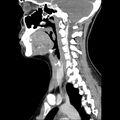Normal CT of the neck (Radiopaedia 14575-14500 Sagittal C+ 23).jpg