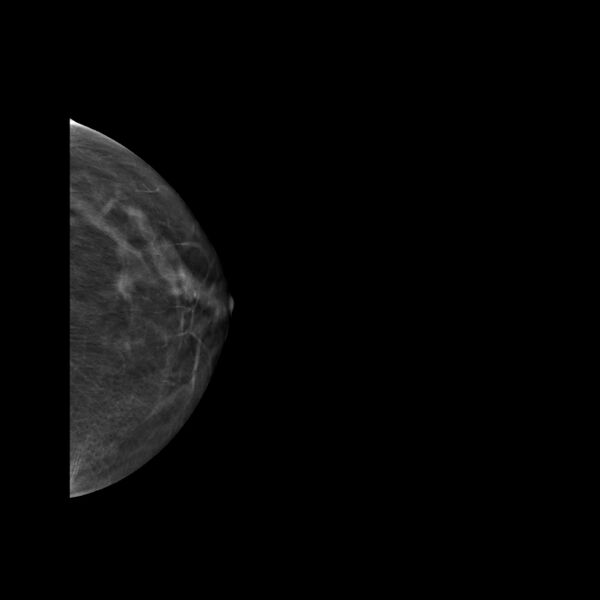 File:Normal breast mammography (tomosynthesis) and ultrasound (Radiopaedia 65325-74353 LCC Tomo 2).jpeg