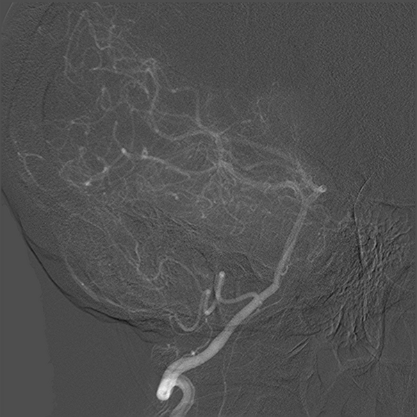 File:Normal cerebral angiogram (four vessel DSA) (Radiopaedia 41708-44649 O 10).png