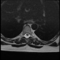 Normal cervical and thoracic spine MRI (Radiopaedia 35630-37156 H 28).png