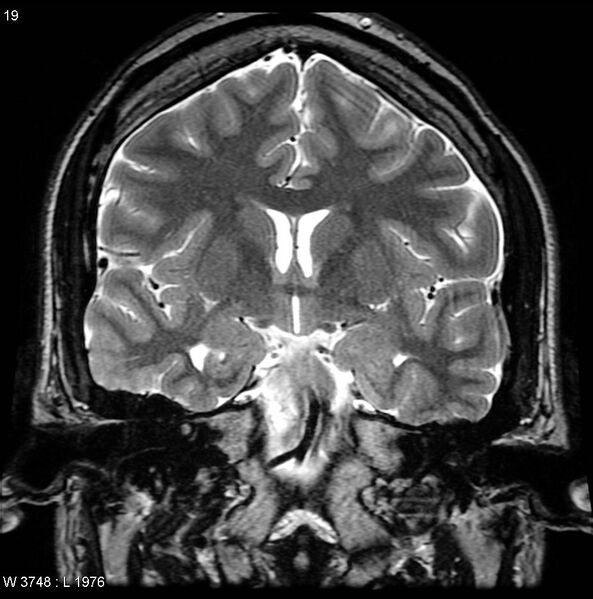 File:Normal coronal brain (Radiopaedia 6676-7910 Coronal T2 19).jpg