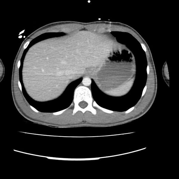 File:Normal dual-phase trauma CT chest,abdomen and pelvis (Radiopaedia 48092-52899 A 48).jpg
