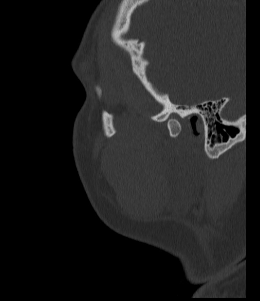 Normal facial bone CT (Radiopaedia 88742-105476 Sagittal bone window 29).jpg