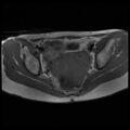 Normal female pelvis MRI (retroverted uterus) (Radiopaedia 61832-69933 Axial T1 17).jpg