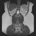 Normal liver MRI with Gadolinium (Radiopaedia 58913-66163 Coronal T2 32).jpg