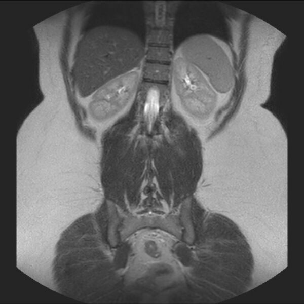 File:Normal liver MRI with Gadolinium (Radiopaedia 58913-66163 Coronal T2 32).jpg