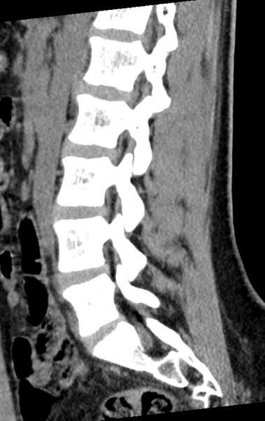 File:Normal lumbar spine CT (Radiopaedia 46533-50986 C 44).png