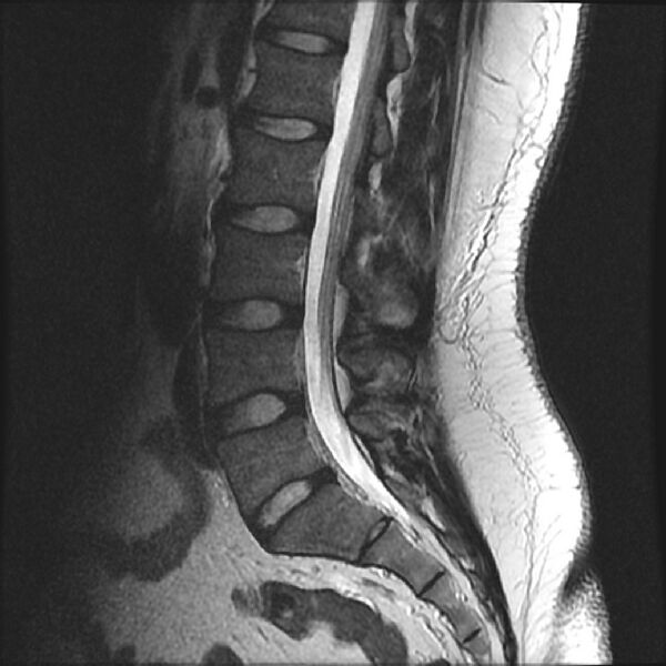 File:Normal lumbar spine MRI (Radiopaedia 43051-46311 Sagittal T2 11).jpg