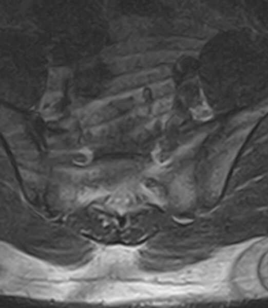 File:Normal lumbar spine MRI - low-field MRI scanner (Radiopaedia 40976-43699 Axial T2 98).jpg