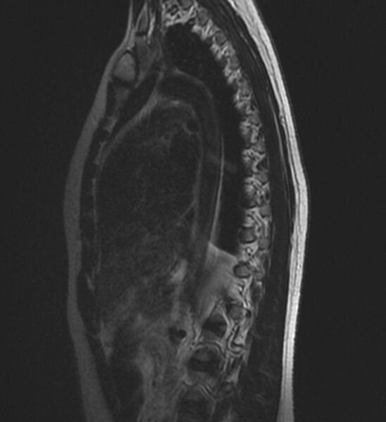 File:Normal thoracic spine MRI (Radiopaedia 41033-43781 Sagittal T2 12).jpg