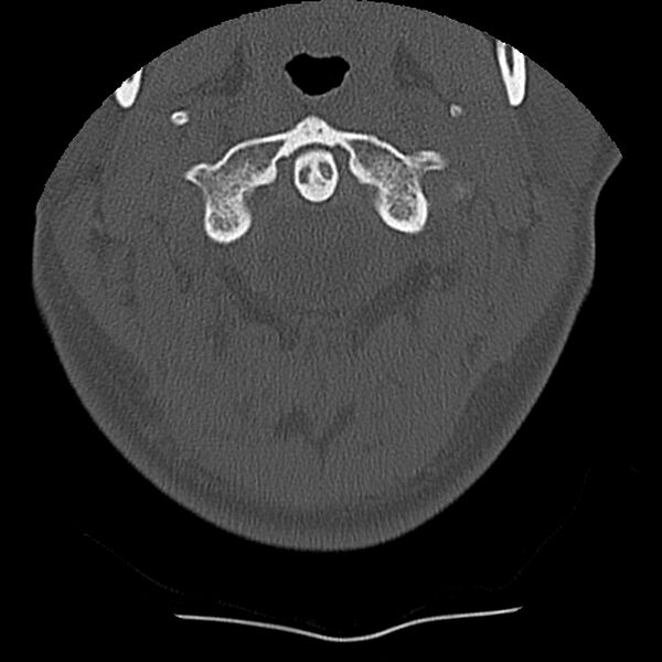File:Normal trauma spine imaging (Radiopaedia 31753-32686 Axial bone window 9).jpg