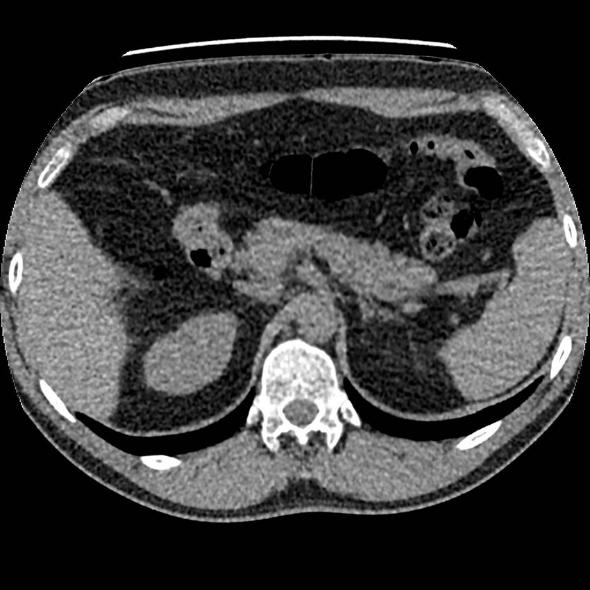 Obstructing ureteric calculus and ureteric anatomy (Radiopaedia 62730-71042 Axial non-contrast 13).jpg