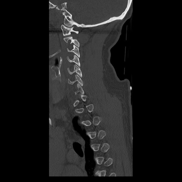 File:Occipital condyle fracture (Radiopaedia 31755-32691 Sagittal bone window 9).jpg