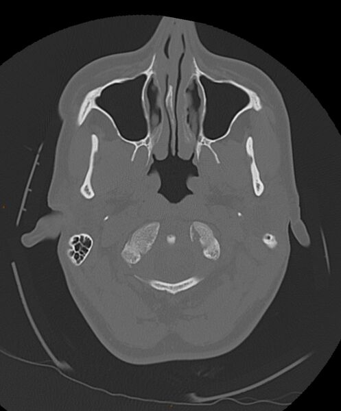 File:Occipital condyle fracture (Radiopaedia 61165-69056 Axial bone window 24).jpg