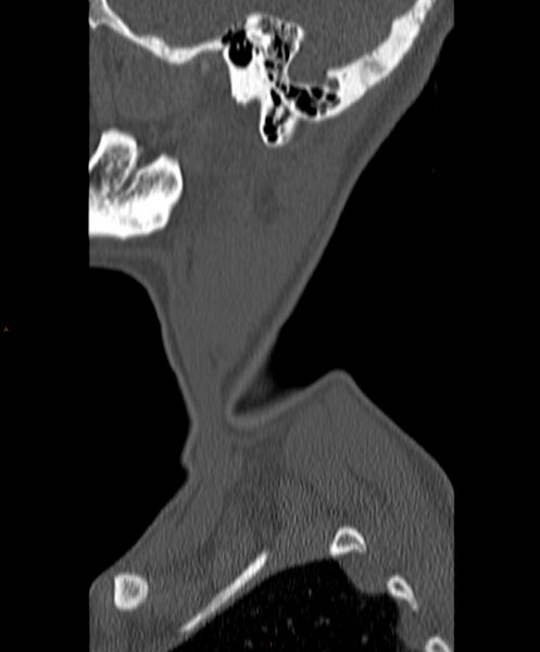 File:Occipital condyle fracture (Radiopaedia 61165-69056 Sagittal bone window 2).jpg
