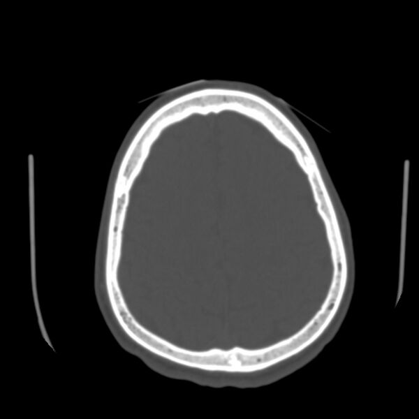 File:Occipital spur - asymptomatic (Radiopaedia 87753-104201 Axial bone window 165).jpg