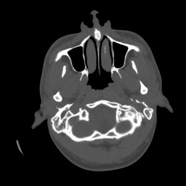File:Occipital spur - asymptomatic (Radiopaedia 87753-104201 Axial bone window 7).jpg