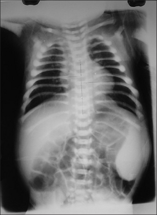 X-ray showing increased density in all the bones-Malignant infantile osteopetrosis