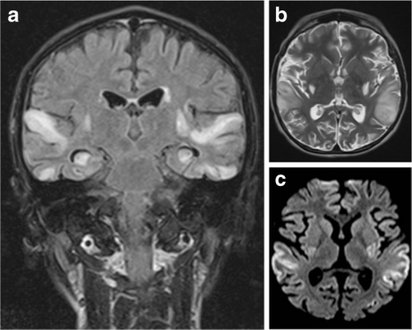 a)Symmetrical high signal intensities lesions in multiple arterial territories b)high signal cortical and subcortical lesions bilaterally in the edematous superior temporal gyri c)high signal areas in the same regions