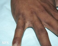 Scabies of the finger