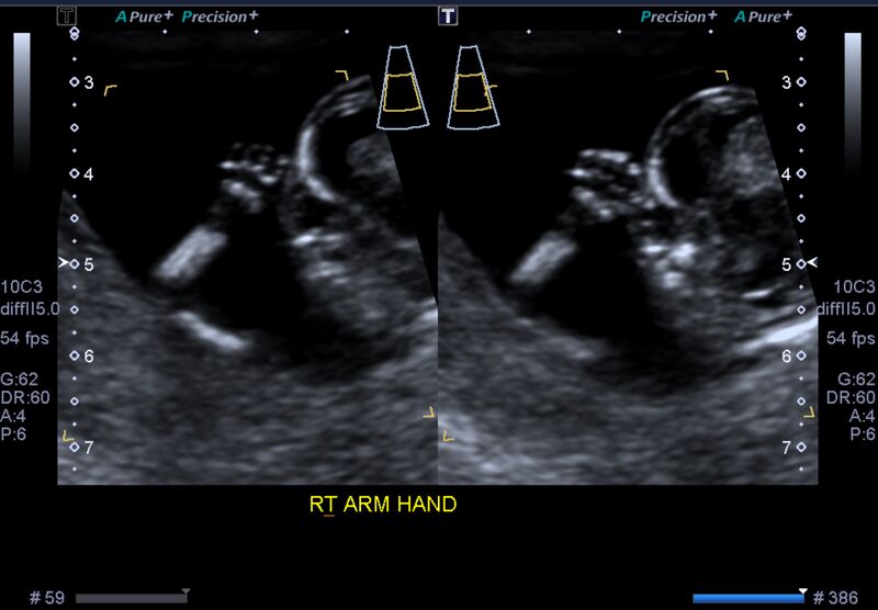 File:1st trimester nuchal-morphology ultrasound (Radiopaedia 44706-48477 General anatomy and NT 32).jpg