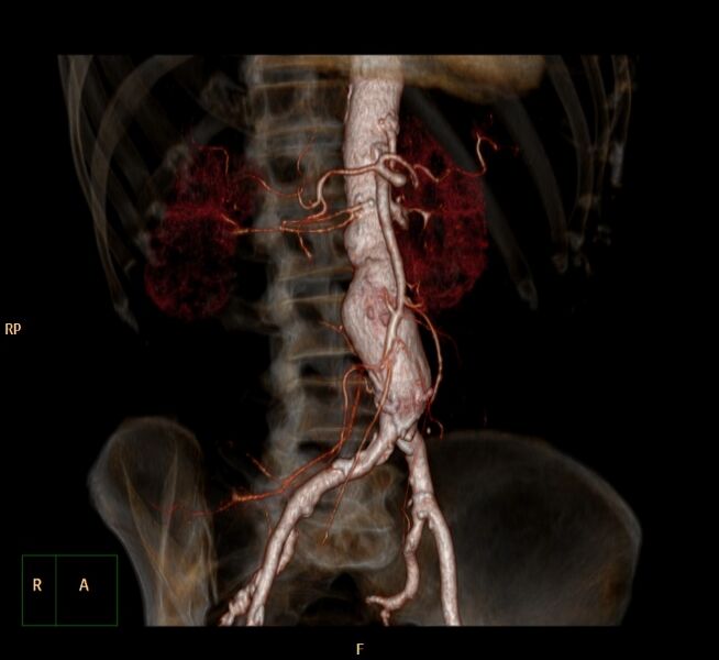 File:Abdominal aortic aneurysm (Radiopaedia 23703-23856 3D 3).jpg