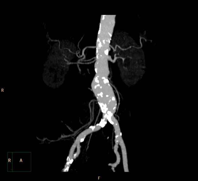 File:Abdominal aortic aneurysm (Radiopaedia 23703-23856 MIP 2).jpg