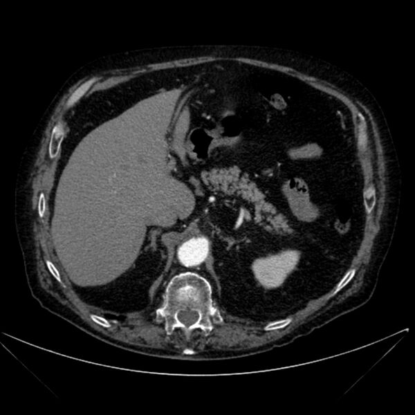 File:Abdominal aortic aneurysm (Radiopaedia 25855-26001 Axial C+ arterial phase 38).jpg