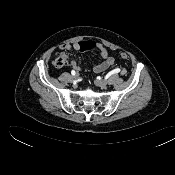 File:Abdominal aortic aneurysm (Radiopaedia 75131-86203 Axial C+ arterial phase 36).jpg