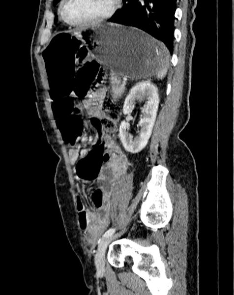 File:Abdominal aortic aneurysm (Radiopaedia 83581-98689 Sagittal C+ portal venous phase 95).jpg