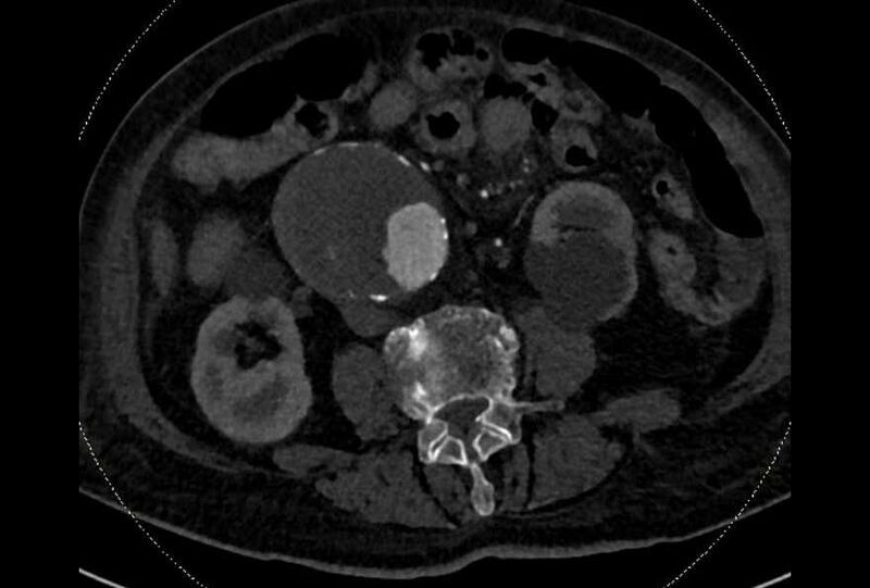 File:Abdominal aortic aneurysm with thrombus fissuration (Radiopaedia 73192-83919 Axial C+ arterial phase 111).jpg