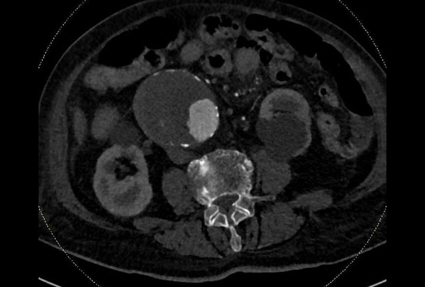 Abdominal aortic aneurysm with thrombus fissuration (Radiopaedia 73192-83919 Axial C+ arterial phase 111).jpg