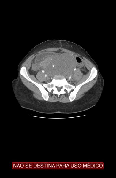 File:Abdominal desmoid tumor (Radiopaedia 44024-47540 Axial C+ arterial phase 30).jpg