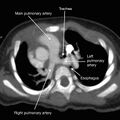 Aberrant left pulmonary artery (pulmonary sling) (Radiopaedia 42323-45436 Annotated MIP image 1).jpg