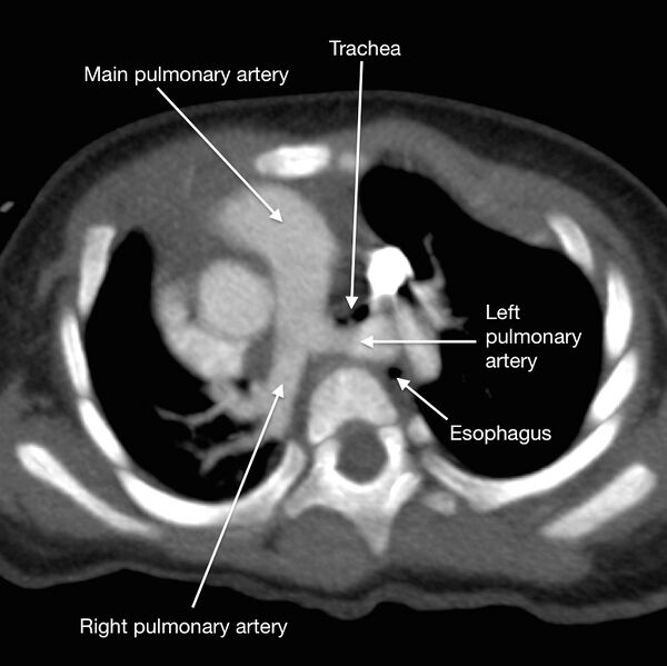 File:Aberrant left pulmonary artery (pulmonary sling) (Radiopaedia 42323-45436 Annotated MIP image 1).jpg