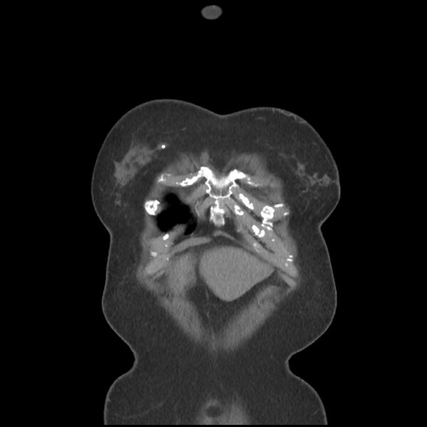 File:Aberrant right subclavian and left vertebral arteries (Radiopaedia 43467-46847 Coronal C+ portal venous phase 6).jpg