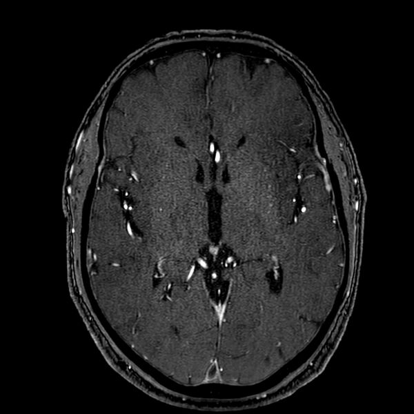 File:Accessory middle cerebral artery (Radiopaedia 73114-83828 Axial MRA 100).jpg