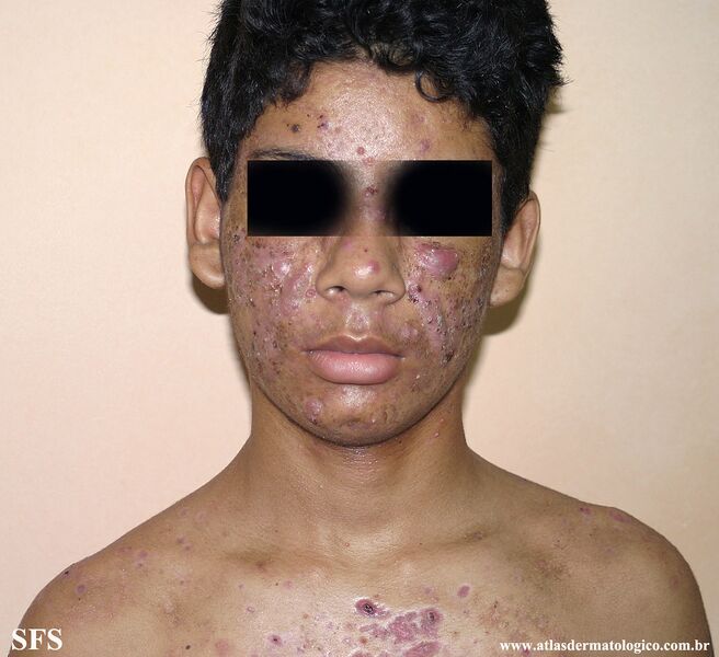 File:Acne (Dermatology Atlas 35).jpg