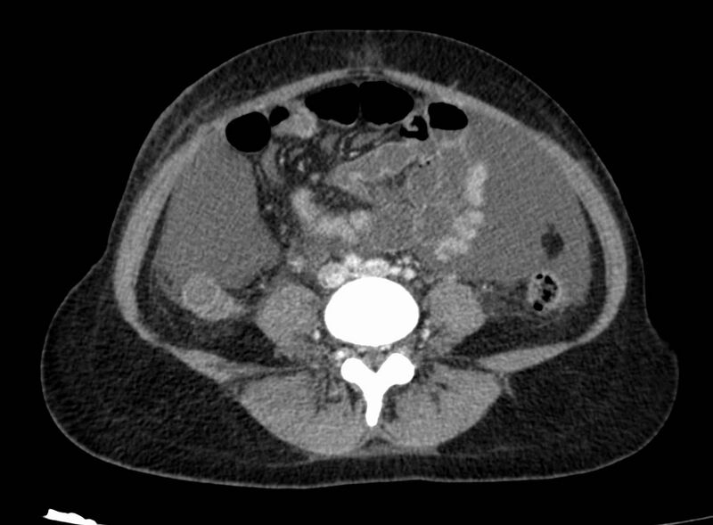 File:Acute Budd-Chiari syndrome (Radiopaedia 60858-68638 Axial C+ portal venous phase 194).jpg
