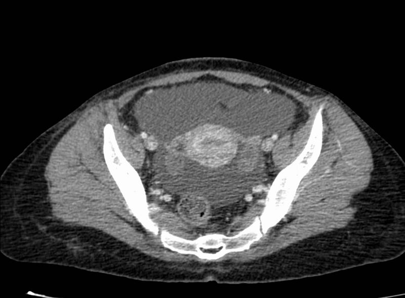 File:Acute Budd-Chiari syndrome (Radiopaedia 60858-68638 Axial C+ portal venous phase 251).jpg