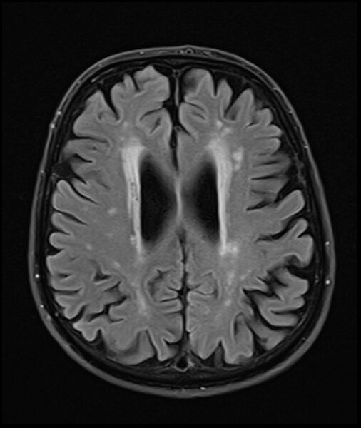 File:Acute P1 occlusion with PCA ischemia penumbra (CT perfusion) (Radiopaedia 72084-82590 Axial FLAIR 25).jpg