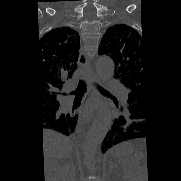 File:Acute and chronic vertebral compression fractures (Radiopaedia 31608-32494 Coronal bone window 10).jpg