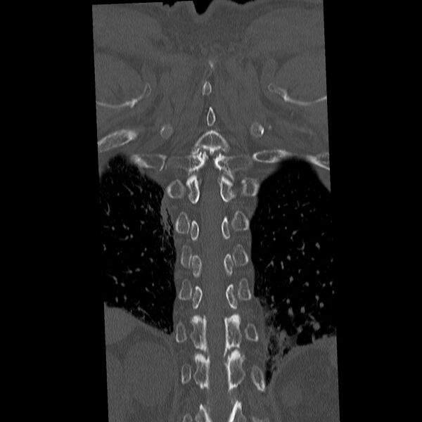 File:Acute and chronic vertebral compression fractures (Radiopaedia 31608-32494 Coronal bone window 37).jpg
