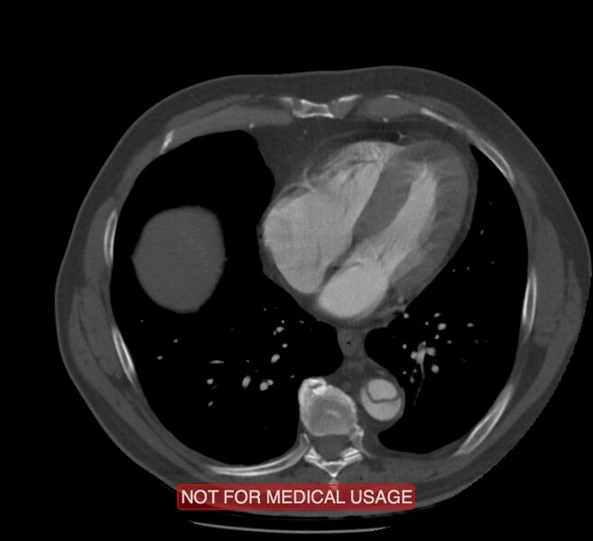 File:Acute aortic dissection - Stanford type A (Radiopaedia 40661-43285 Axial C+ arterial phase 48).jpg