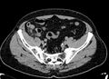 Acute appendicitis (Radiopaedia 13030-13091 Axial non-contrast 58).jpg