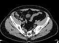 Acute appendicitis (Radiopaedia 13030-13091 Axial non-contrast 66).jpg